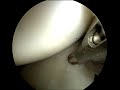 Reparación de Lesion de Bankart - Hombro