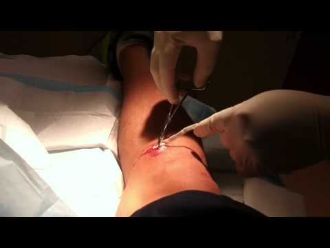 Staph Infection