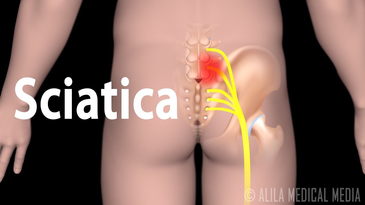 Sciatica anal burning