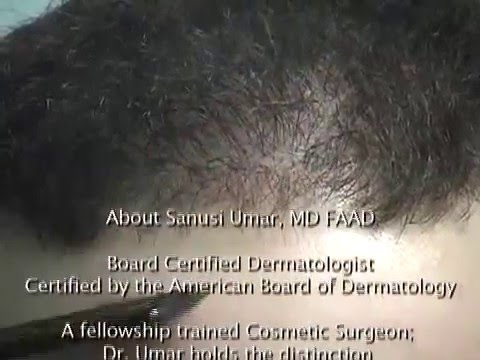 Hair Restoration by FUE and BHT Baldness treatment with beard hair 