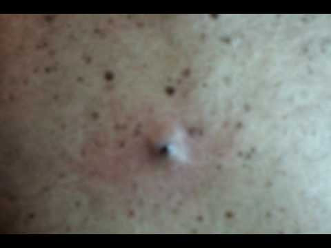 extraction facial yes or no remove blackheads near nose