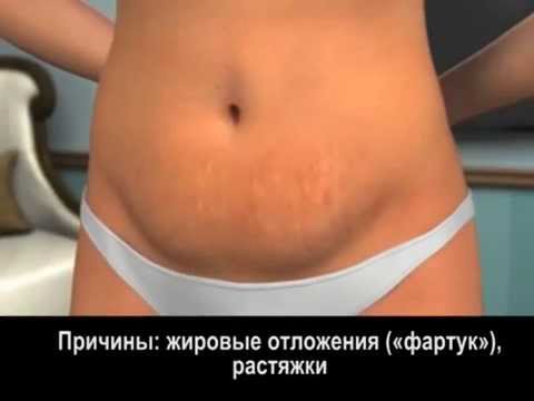 Абдоминопластика - пластика живота Абдоминопластика - пластика живота
