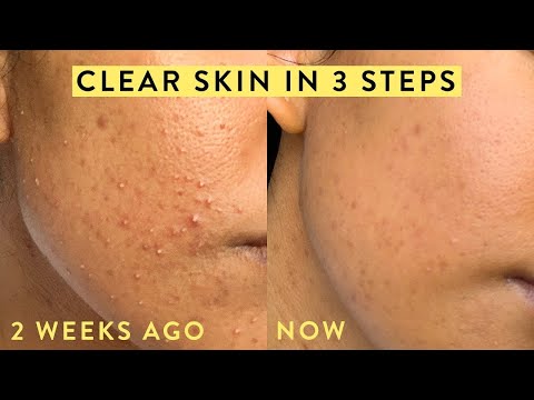 HOW TO IMPROVE SKIN TEXTURE IN 1-2 WEEKS - YouTube