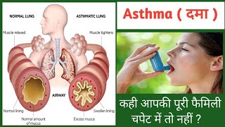 Asthma (दमा ) का लक्षण, जांच एवम इलाज | Bronchial Asthma @biharibiology