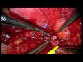 Anastomosis