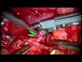 Anastomosis