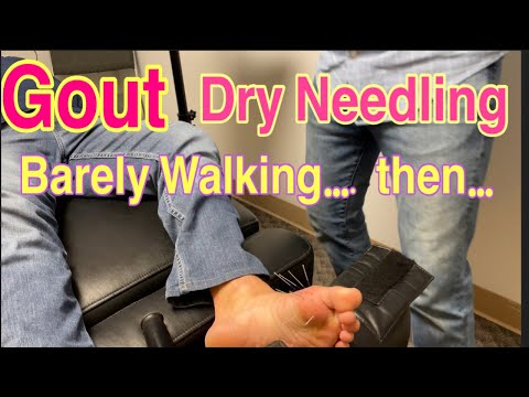 Gout and Dry Needling