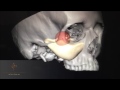 Custom Facial Implant Creation 3d Modeling Session Dr. Philip Young Seattle | Bellevue WA