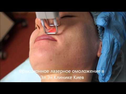 Лазерная шлифовка лица Лазерная шлифовка лица