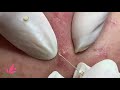How to remove blackheads and whiteheads on face step by step - acne treatment vlogs #4