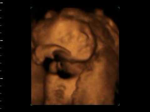 3d ultrasound pictures at 26 weeks. Baby Bea @ 26 weeks in utero 3d/4d Ultrasound