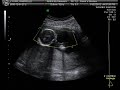 Baby BOY 17 Week Ultrasound on January 27 2012