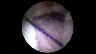 Hip Capsule Reconstruction Using Regeneten