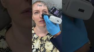Dissolving Tear Trough Filler Dr. Medispa