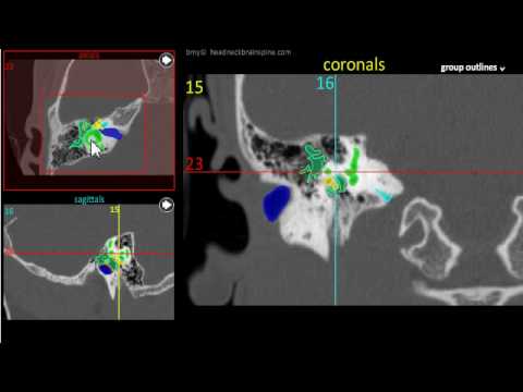 Temporal Bone CT Anatomy Module Tutorial - YouTube