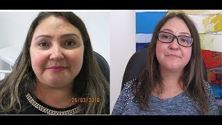 Cristiane - Dermatomiosite