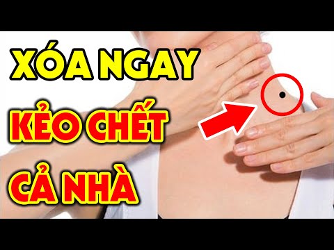 6 Nốt Ruồi NGHÈO KHỔ CẢ ĐỜI Và Cách Giải Vận GIÀU LÊN NHANH CHÓNG Tiền Bạc Ùn Ùn Kéo Đến