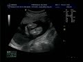 Eco Lenny, 20 semanas, 30.04.13