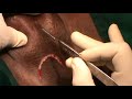 Penectomy