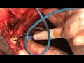 Penectomy