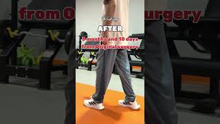 Limb Lengthening Surgery Height Increase Surgery Recovery From Height Surgery