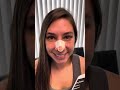 Septorhinoplasty/Sinus Surgery 5 days ago and doing well