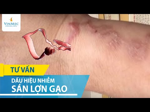 Dấu hiệu khi nhiễm sán lợn | Sán lợn có nguy hiểm không?