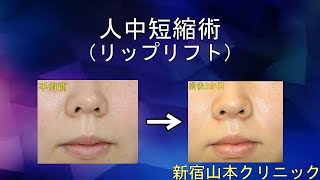 人中短縮(リップリフト) 山本クリニック