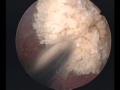 Cystolithotripsy (Bladder Calculi Removal) by Dennis G. Lusaya, MD FPCS, Manila, Philippines
