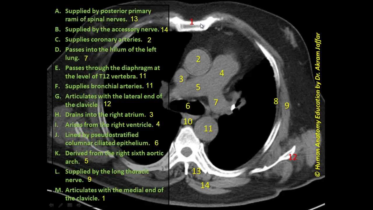 Anatomy question - superior mediastinum - axial CT 2 - YouTube