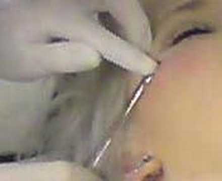 Tags:micro dermal piercing implant neck flowerpush Tags:micro dermal piercing implant neck flowerpush