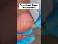 Remove Cracked Heels - So satisfying, 6 mins Cracked heel treatment by miss foot fixer