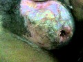 Scrotal Abscess Ruptured