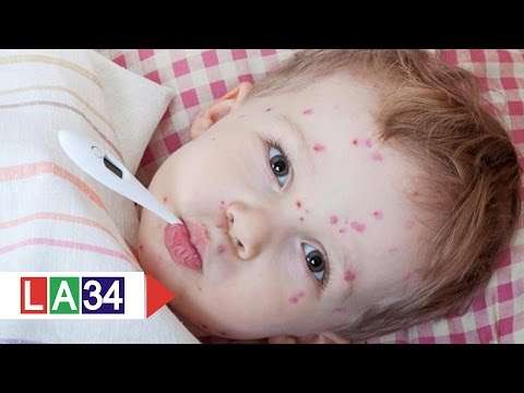Điều trị đúng cách bệnh Zona thần kinh | LATV