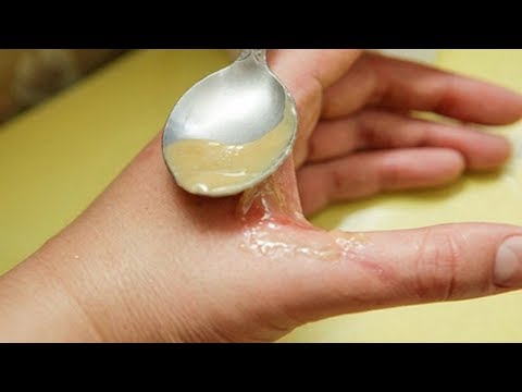 Bỏng bô, bỏng nước sôi hay bỏng do dầu mỡ đều khỏi ngay lập tức chỉ nhờ 1 quả trứng gà