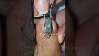 Removing A Painful Ingrown Toenail 40-Year-Old Woman Foot Treatment