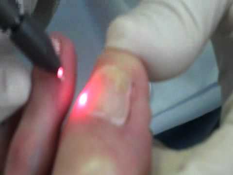 Nail Fungus Herbal Remedy San Francisco