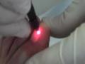 NEW PinPoint Laser for Toe Nail Fungus