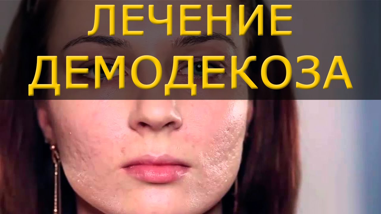 Лечение демодекса на лице в домашних условиях Лечение демодекса на лице в домашних условиях