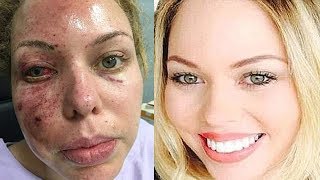 Former beauty queen sues government after flash grenades melted the skin off her face