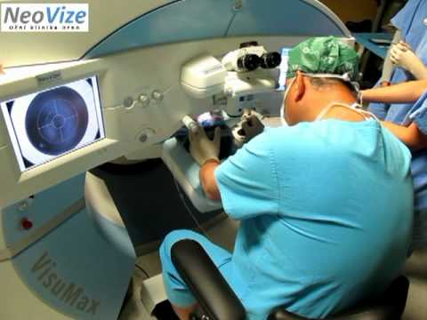lasik eye surgery 16 year old
 on LASIK in 11-years old girl with femtosecond laser VisuMax in NeoVize ...