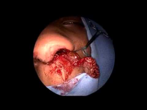 Functional endoscopic sinus surgery (FESS) was done by Dr ...