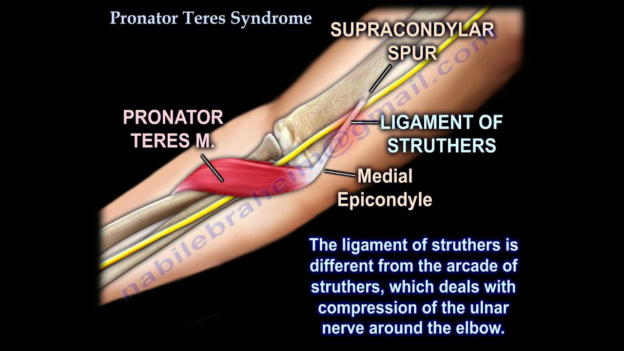 Pronator Teres Syndrome - Everything You Need To Know - Dr. Nabil