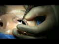 Eyelid Ptosis Correction Surgery in High Speed