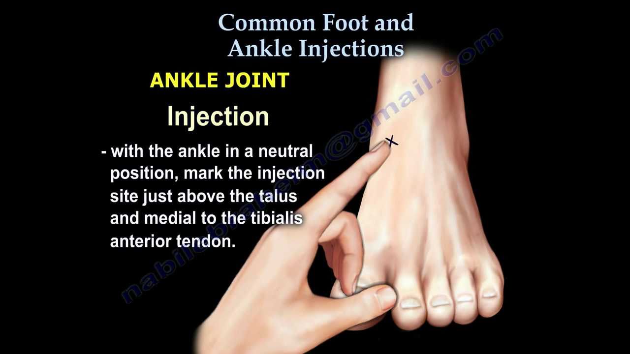Common Foot And Ankle Injections - Everything You Need To Know - Dr