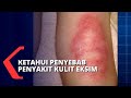 Cara Mencegah Penyakit Kulit Dermatitis Atopik atau Eksim