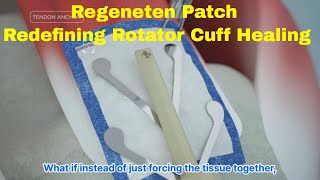 Beyond Sches How The Regeneten Patch Is Redefining Rotator Cuff Healing