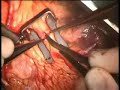 beating heart surgery