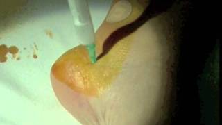 Inifltracion+espolon+calcaneo.+Calcaneal+spur+infiltration