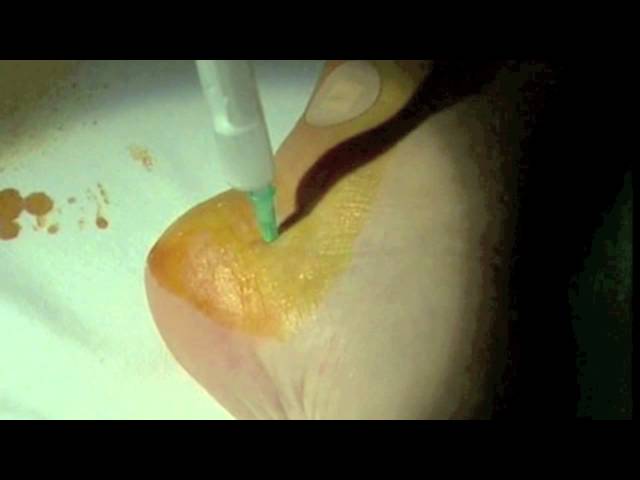 Inifltracion+espolon+calcaneo.+Calcaneal+spur+infiltration